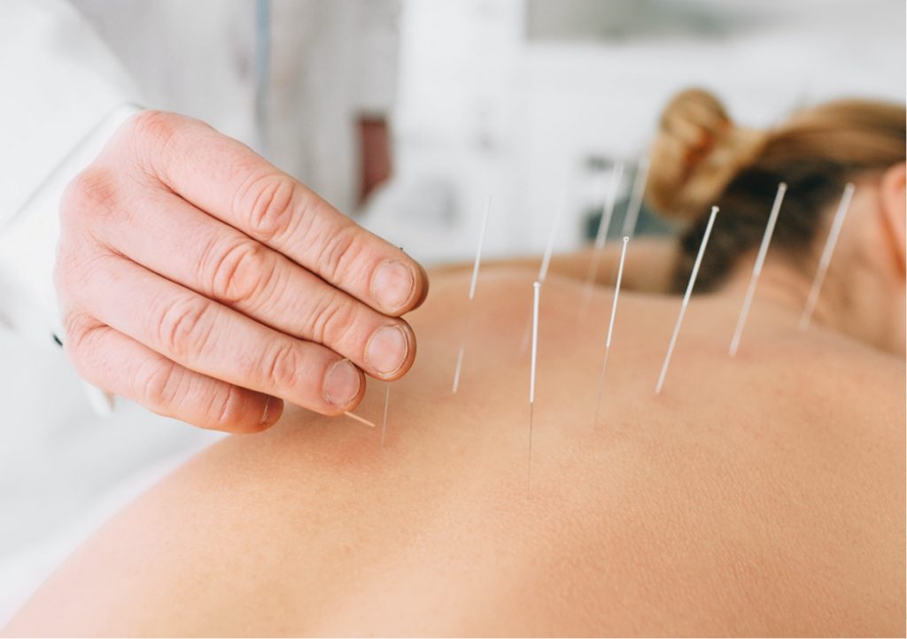 Dry needling treatment on an athlete’s upper back at Forward Physio Tampa
